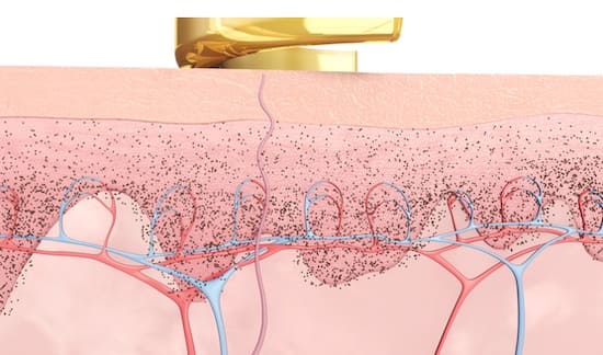 Skin Stains after PicoWay