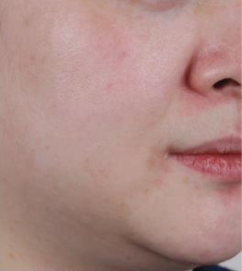 Photoaging and Pores After