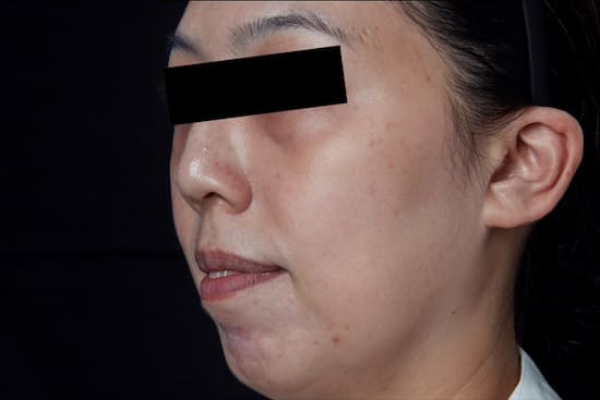 Skin Treatment after PicoWay