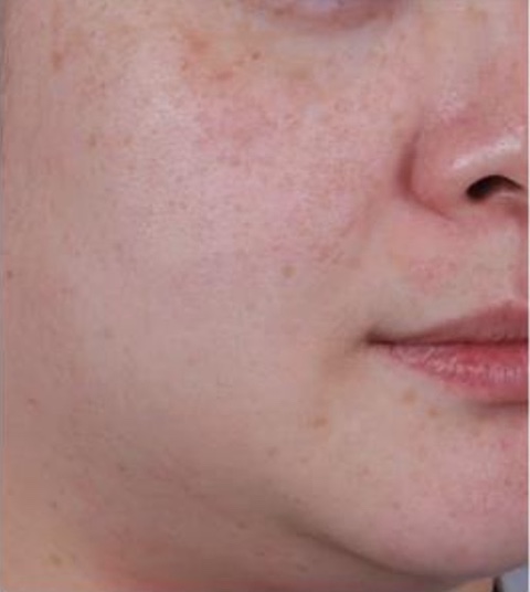 Photoaging and Pores Before